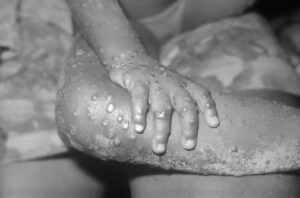 Image of a young girl with monkeypox lesions on her legs and arms. Credit: CDC.