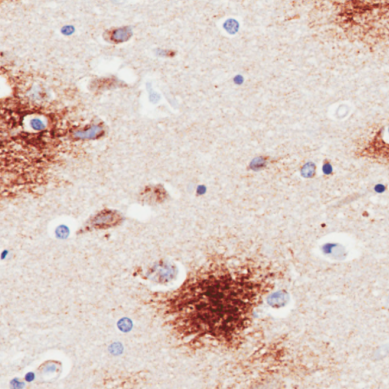 Immunohistochemical staining of human Alzheimer’s disease hippocampus tissue using anti-Amyloid Beta antibody (Ab00714) 6E10